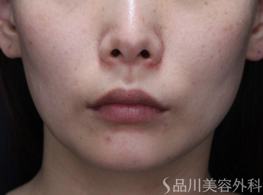 症例NO.74228のBEFORE写真