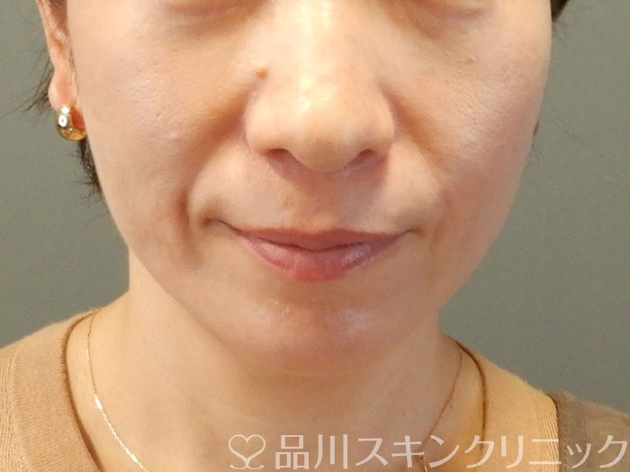 症例NO.62408のBEFORE写真
