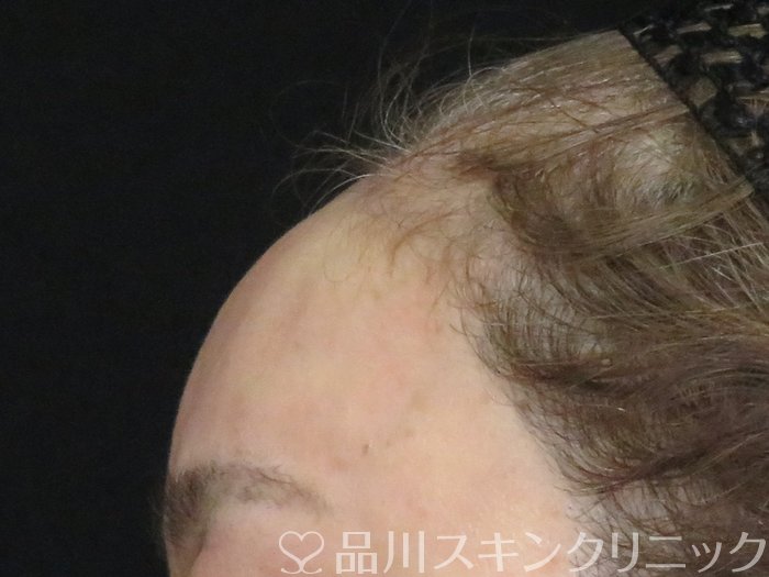 症例NO.67971のAFTER写真