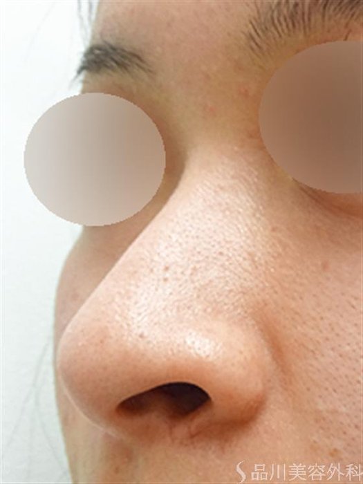 症例NO.33348のBEFORE写真