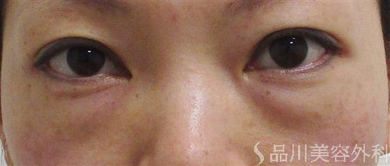 症例NO.55385のBEFORE写真