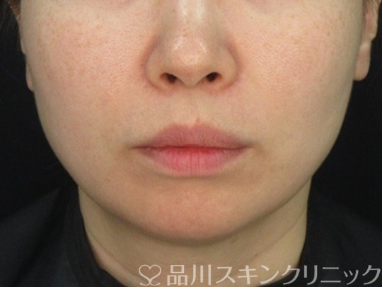 症例NO.74590のBEFORE写真