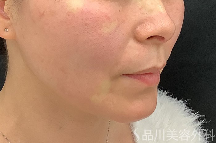 症例NO.73322のAFTER写真