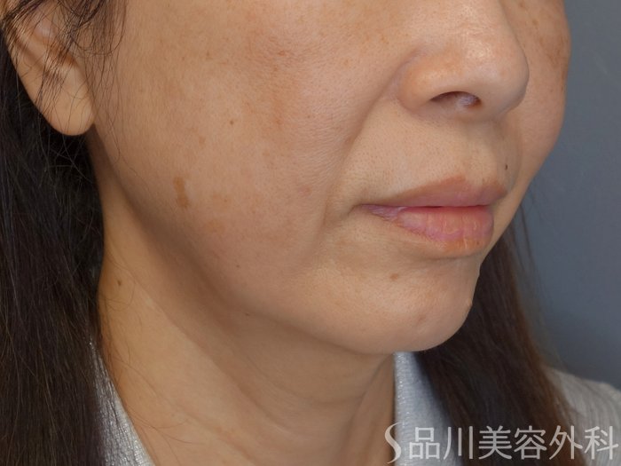 症例NO.72295のBEFORE写真