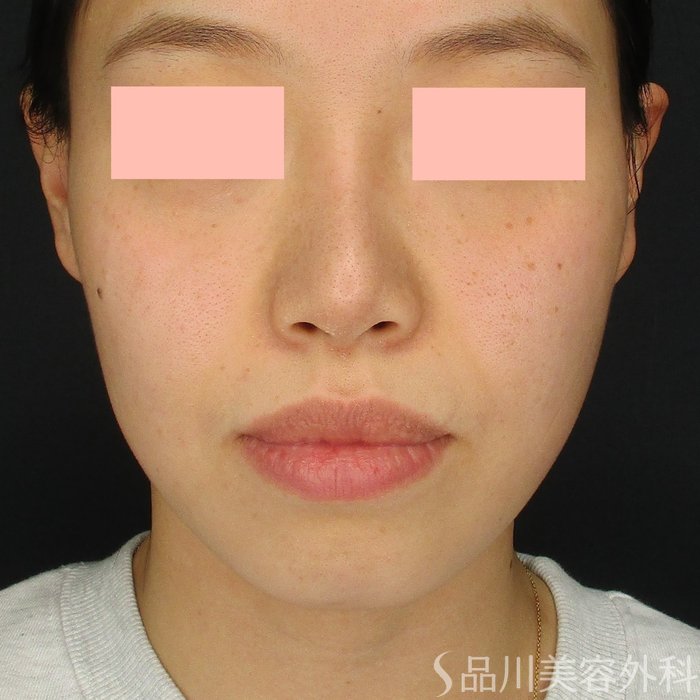 症例NO.73429のBEFORE写真