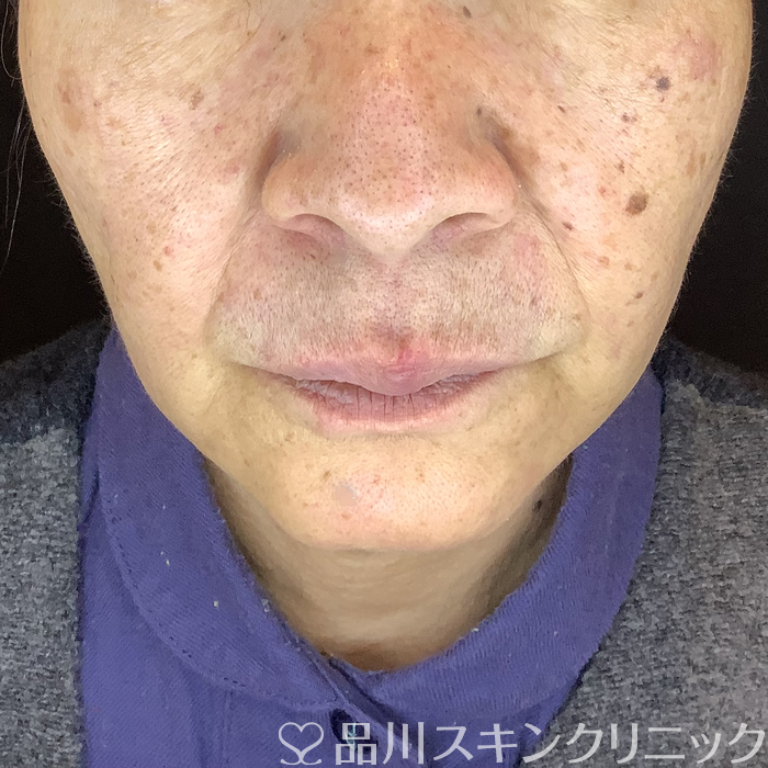 症例NO.62052のBEFORE写真