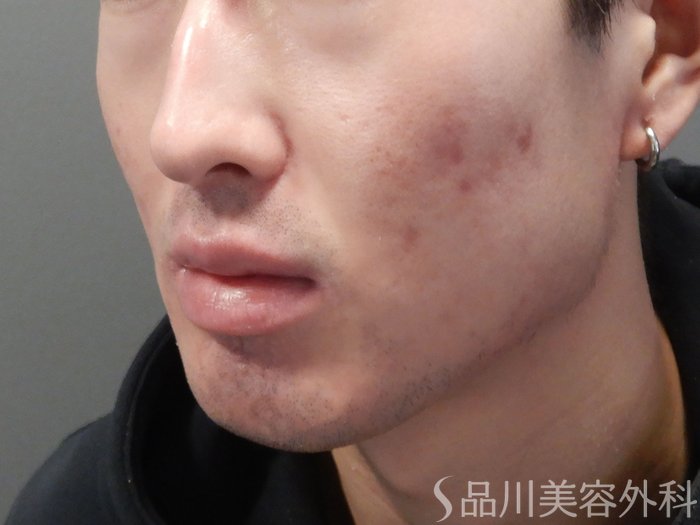 症例NO.72298のAFTER写真