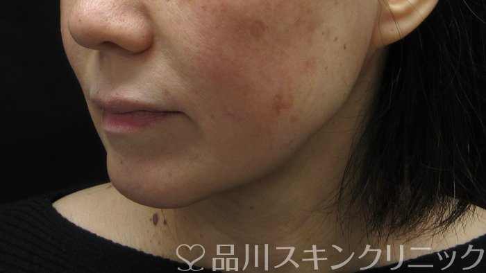 症例NO.71320のBEFORE写真