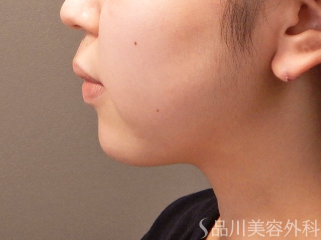 症例NO.70992のAFTER写真