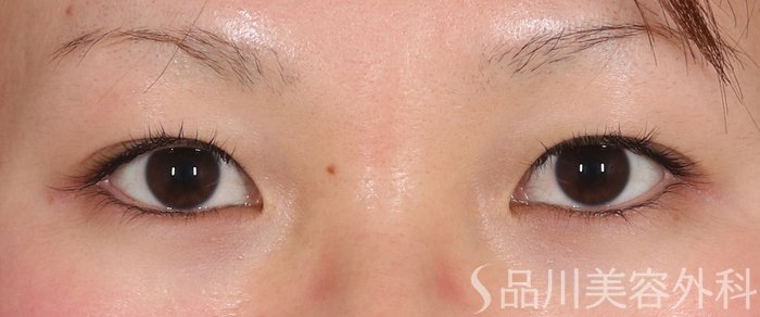 症例NO.73237のBEFORE写真