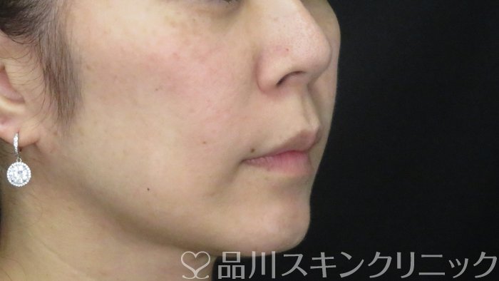 症例NO.72330のAFTER写真