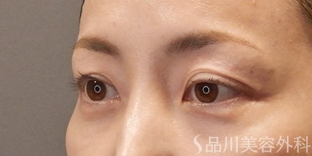 症例NO.74797のAFTER写真