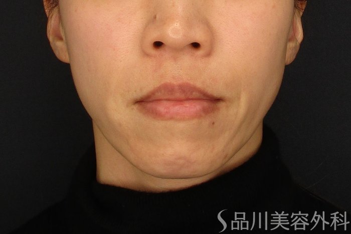 症例NO.70599のBEFORE写真
