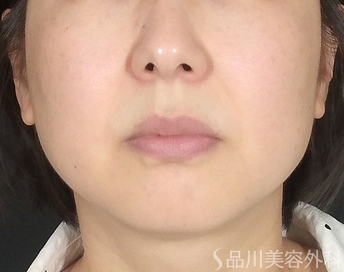 症例NO.65421のBEFORE写真