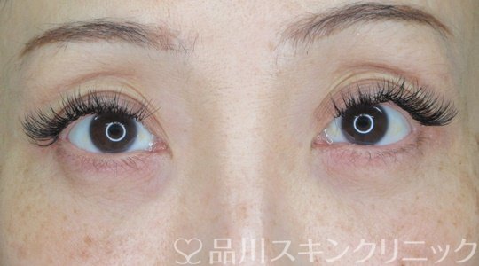 症例NO.69633のAFTER写真