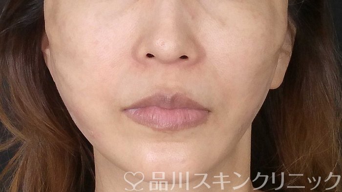 症例NO.71287のAFTER写真