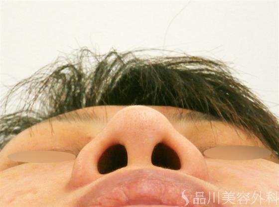 症例NO.25034のAFTER写真