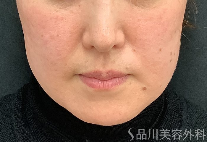 症例NO.69484のBEFORE写真