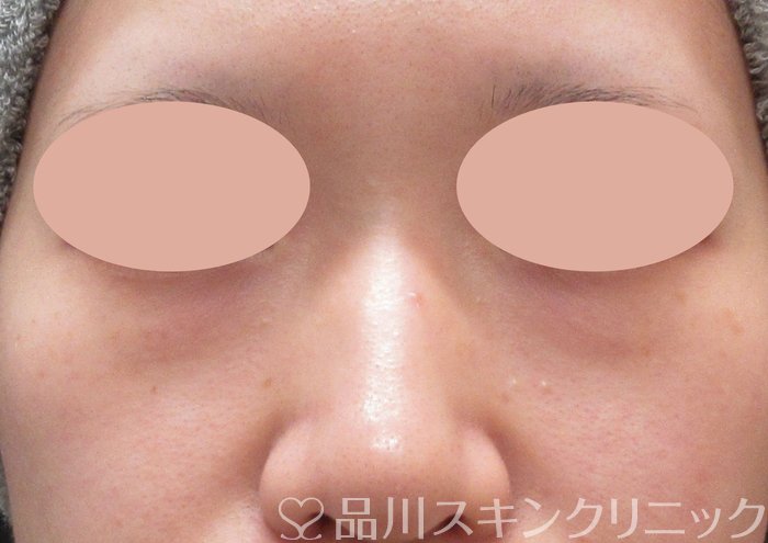 症例NO.73831のBEFORE写真