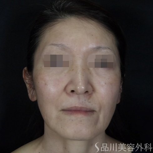 症例NO.70432のBEFORE写真