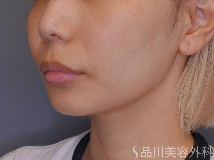 症例NO.74437のBEFORE写真
