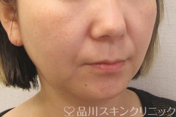 症例NO.70410のBEFORE写真