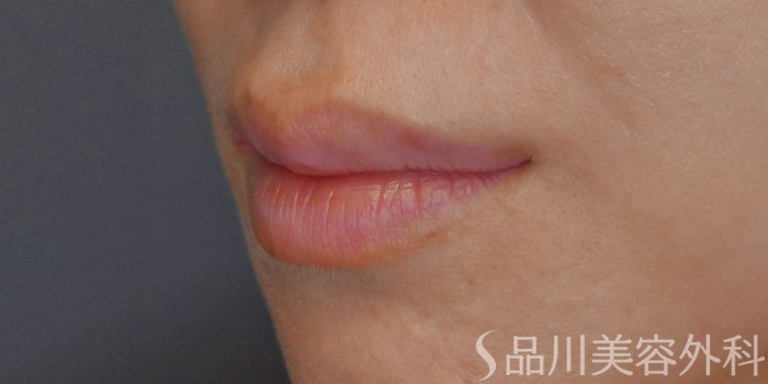 症例NO.71258のBEFORE写真