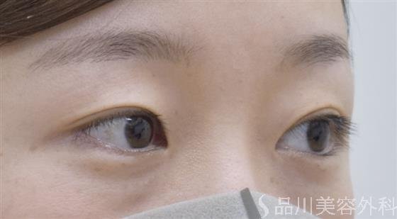 症例NO.51782のBEFORE写真