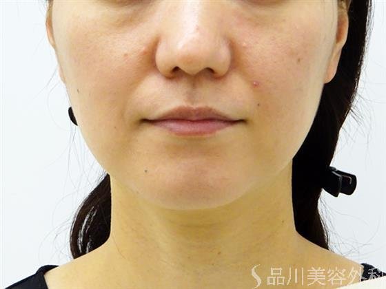 症例NO.52663のBEFORE写真