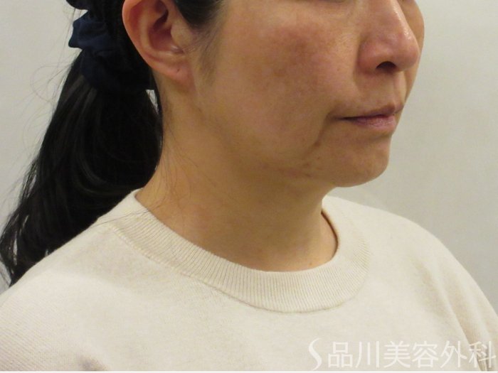 症例NO.74261のBEFORE写真