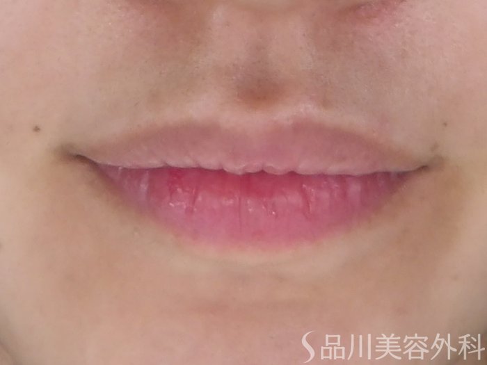 症例NO.69683のBEFORE写真
