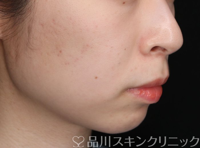 症例NO.65176のAFTER写真