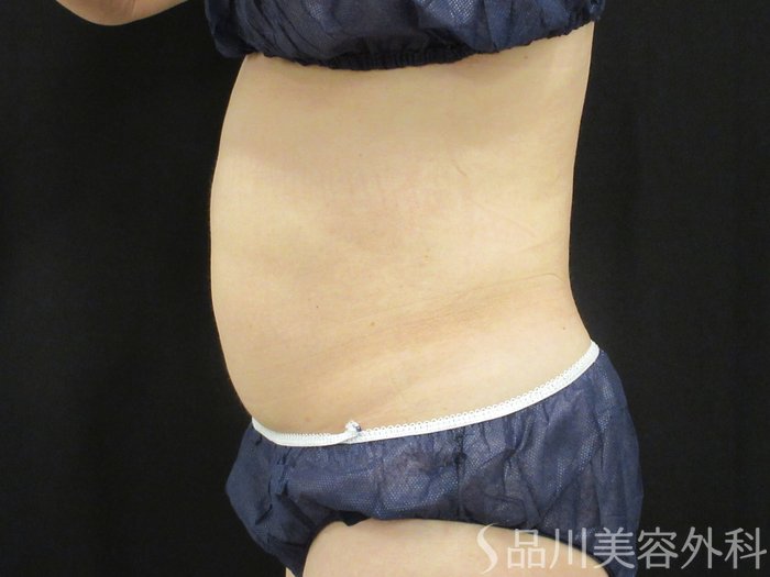 症例NO.75330のAFTER写真