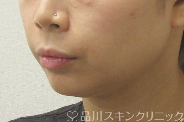 症例NO.74505のAFTER写真