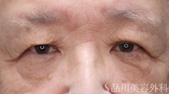 症例NO.74742のBEFORE写真