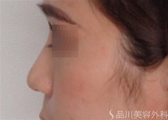 症例NO.47835のBEFORE写真
