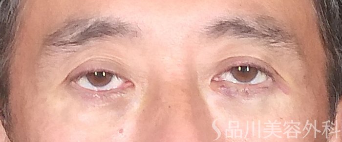 症例NO.65699のAFTER写真