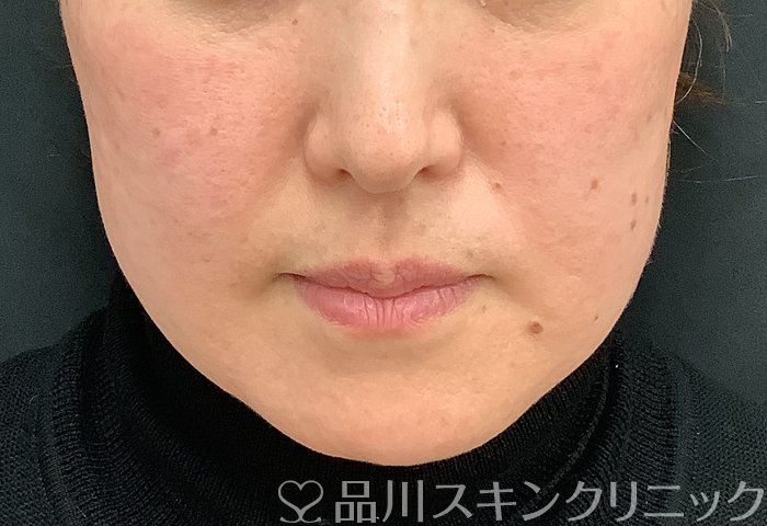 症例NO.69484のBEFORE写真