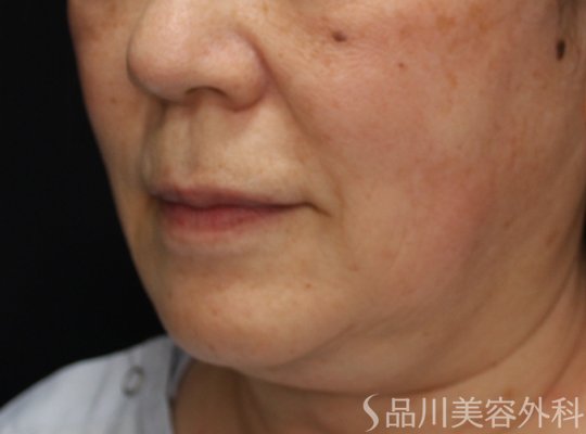 症例NO.73815のBEFORE写真
