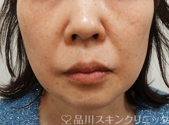 症例NO.70674のBEFORE写真