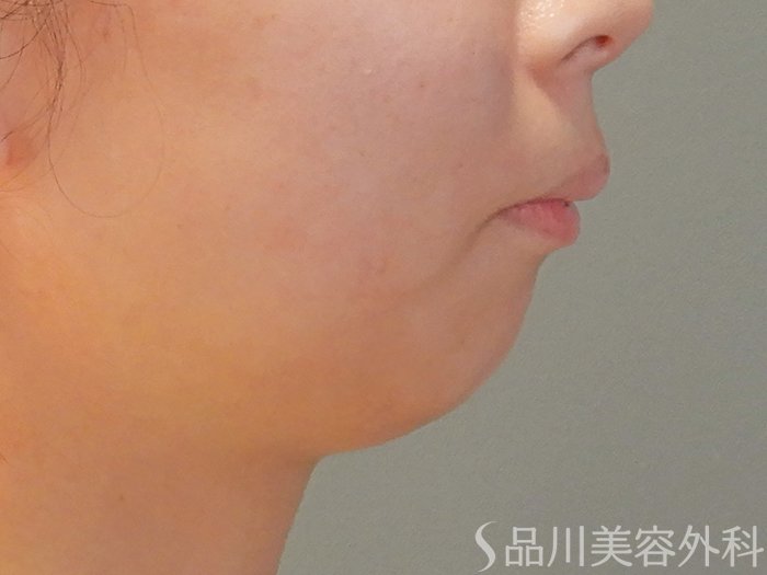 症例NO.69730のBEFORE写真