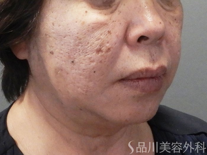 症例NO.70857のAFTER写真