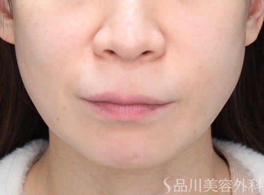 症例NO.69864のAFTER写真