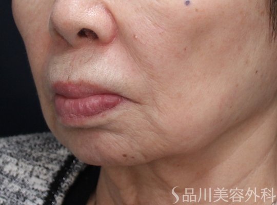 症例NO.73761のBEFORE写真