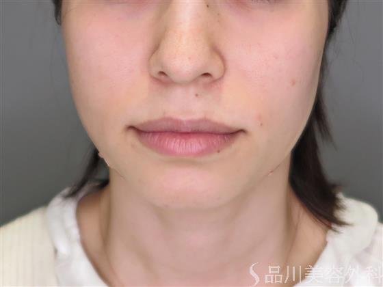 症例NO.49374のAFTER写真