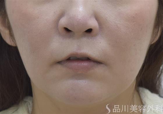 症例NO.46122のBEFORE写真