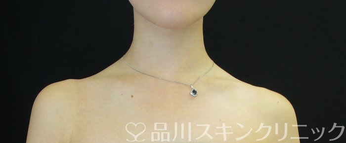 症例NO.73852のAFTER写真