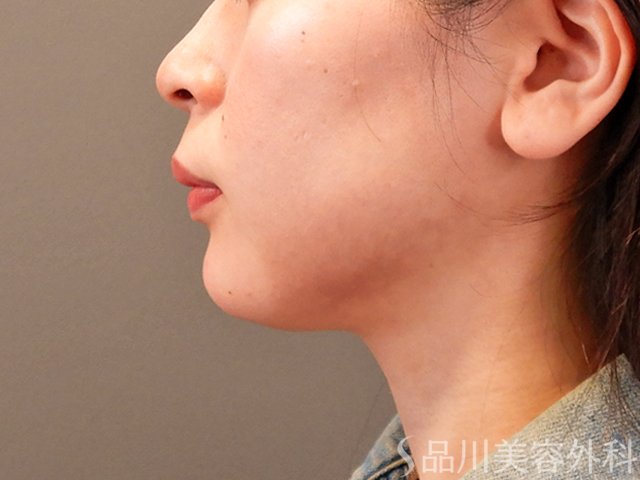 症例NO.69954のAFTER写真