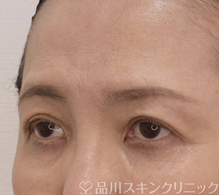 症例NO.71384のAFTER写真