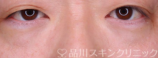 症例NO.70089のBEFORE写真